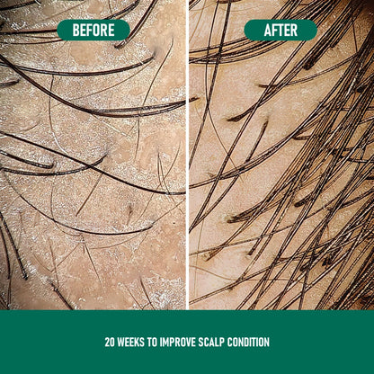 CH004 Minoxidil Anti-Hair Loss Mousse