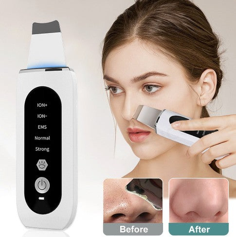 Shovel Skin Blackhead Ultrasonic Beauty - Next Day Delivery